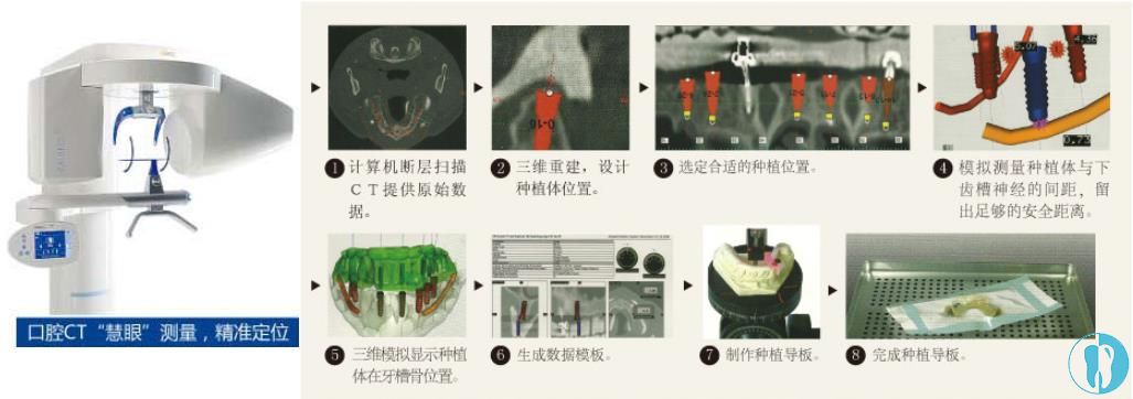 庆6周年广州雅度口腔德国icx种植体1888元起颗包基台和牙冠