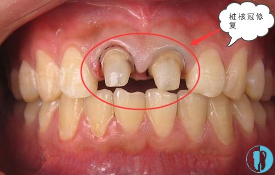 烂牙根治疗后还可以做桩冠修复