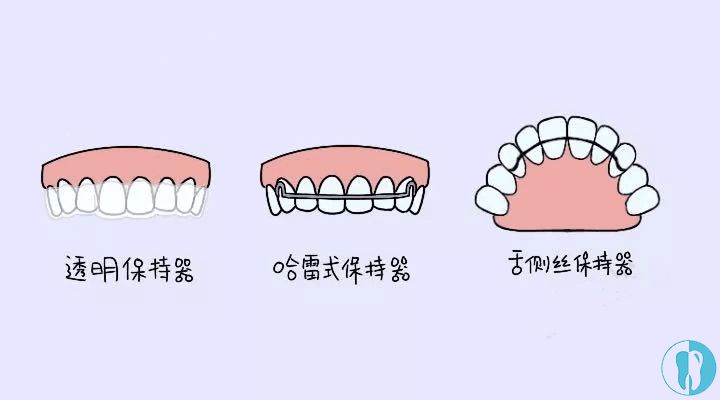 保持器戴了三年还反弹,难道我要戴一辈子吗