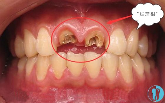 牙根烂成这样要不要拔掉