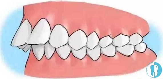 干货篇:如何区分自己的龅牙是骨性还是牙性?