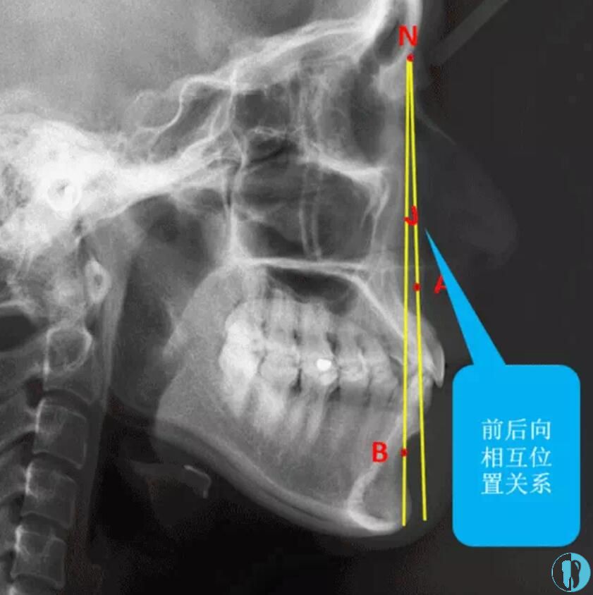 牙性还是骨性,一定是需要结合头影侧位片来测量分析的,因为x光片更能