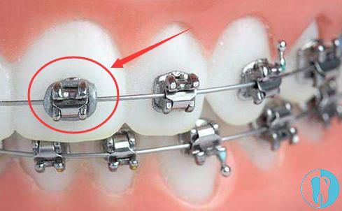 明明很小心:牙齿矫正过程中金属托槽还总掉是咋回事