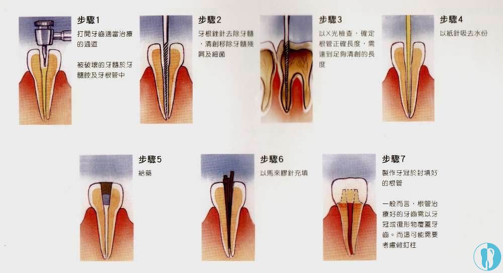 根管治疗的过程