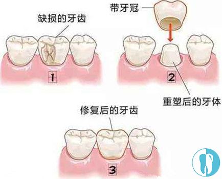 但需要磨损牙齿,然后佩戴牙冠,优点是 时间短,使用多年不出现黑线,但