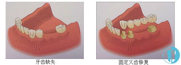 固定假牙修复