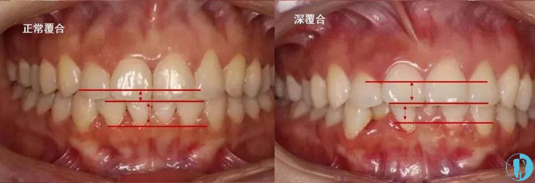 牙齿深覆合和骨性龅牙的区别怎么破?看脸型变化图只是其一