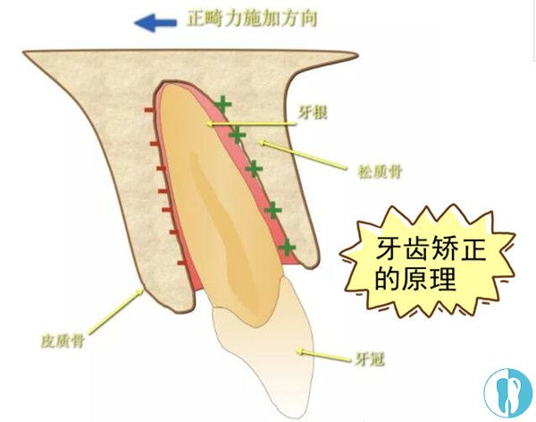 牙齿矫正的原理