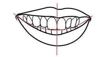 牙齿矫正后期需要调型定型