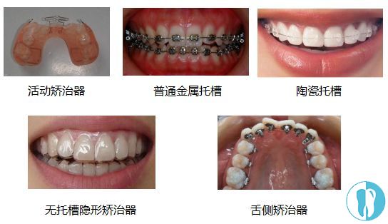 矫正牙套的种类那么多,隐形牙套和钢丝牙套价格差多少嘞