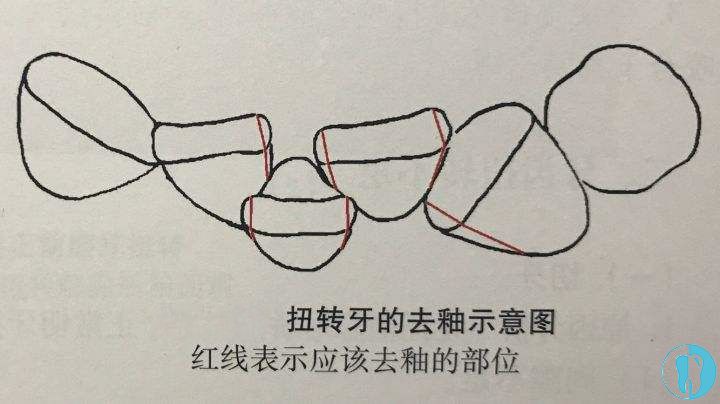 扭转牙去釉示意图