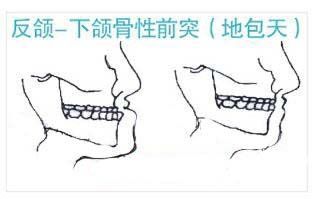 骨性的前牙反合