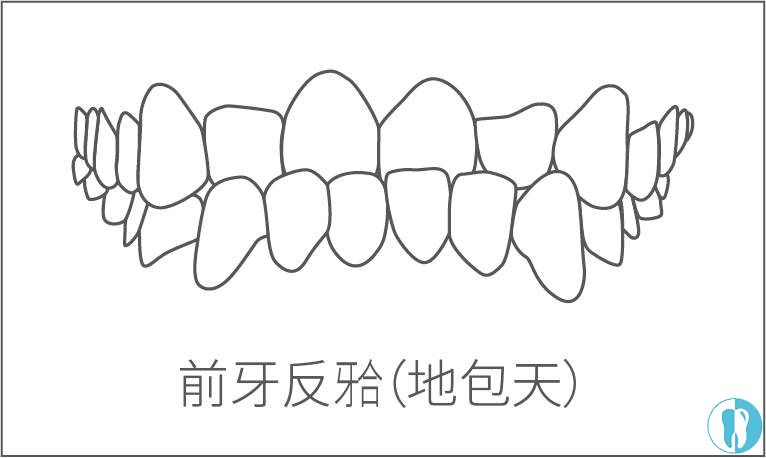 前牙反合症状