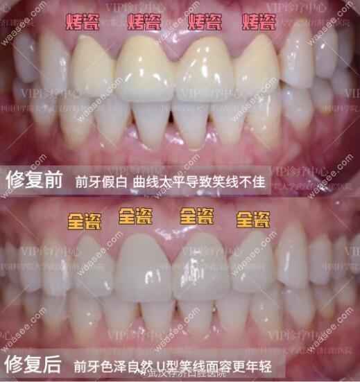 10年烤瓷牙经常被说假,无奈拆掉根管治疗后换了全瓷牙