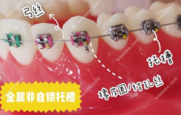 究竟自锁和非自锁牙套哪个好?是否自锁托槽真的略胜一筹