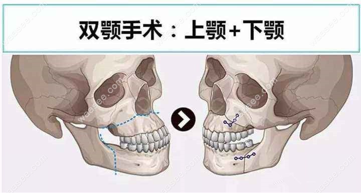 双颌手术