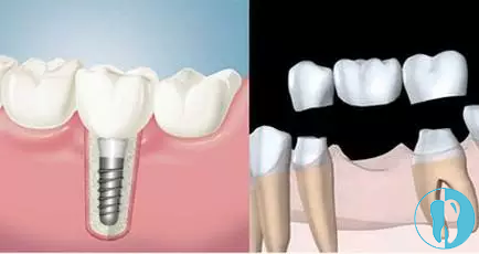 解疑篇：中老年牙齿缺失人群选择种植牙和镶牙哪个比较好