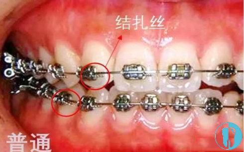 普通金属牙套 普通金属牙套
