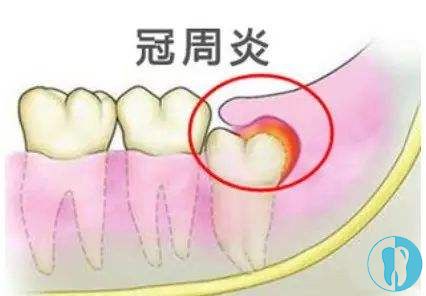 长智齿发炎牙龈肿痛怎么办?难道除了拔掉真的没辙了
