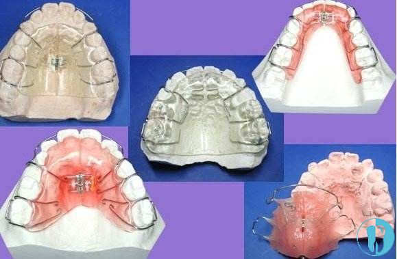 牙齿矫正器种类和图片图片