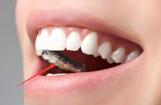 在上海为什么做舌侧矫正的人很少呢?医生一语道破:价格贵呗