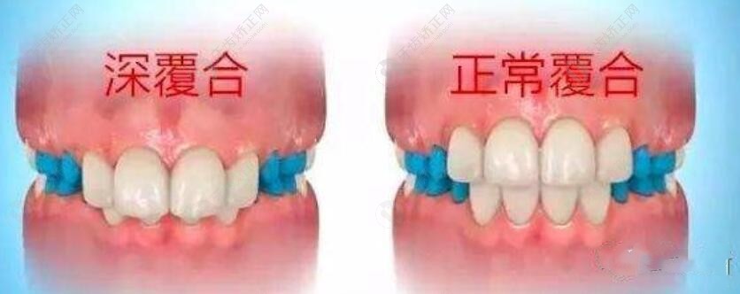 深覆合和正常咬合对比图