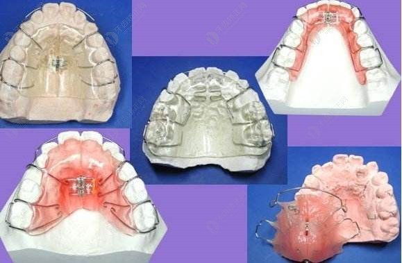 牙齿矫正器类型图片