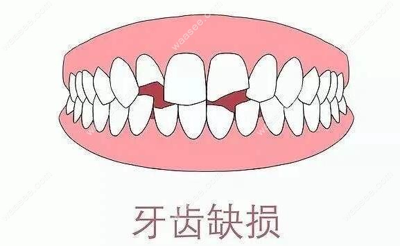 前牙缺损的美容冠修复 前牙缺损的美容冠修复
