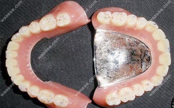 铸造支架活动义齿图片