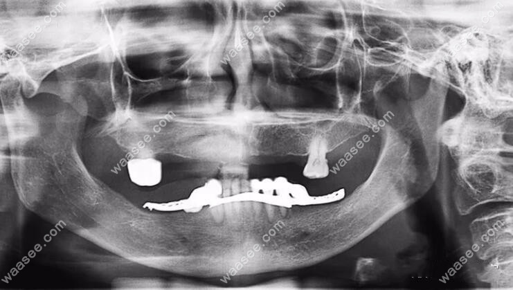 做半口种植牙前拍的CT