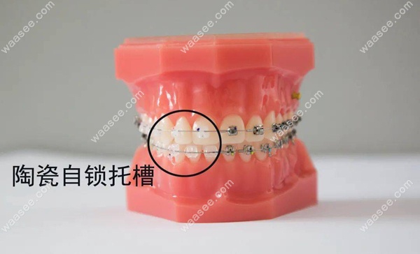 在陶瓷自锁托槽中ormco和3m两家是平分秋色