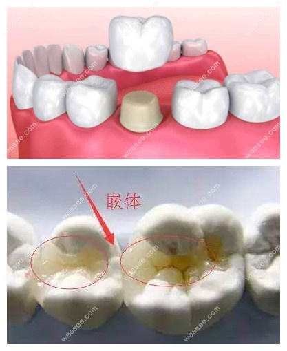 牙齿做嵌体修复一般多少钱一颗?和牙冠有啥区别?