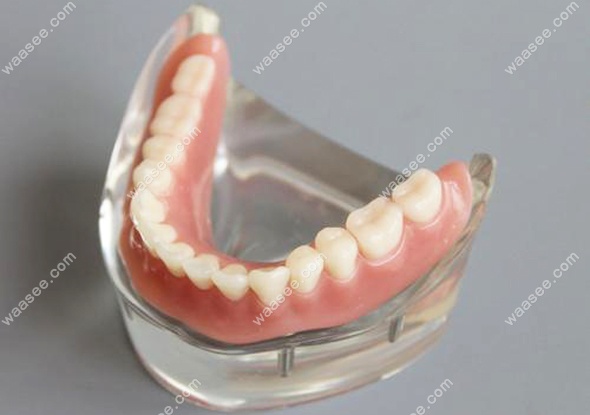 覆盖义齿修复中杆卡式种植覆盖义齿的优缺点分析