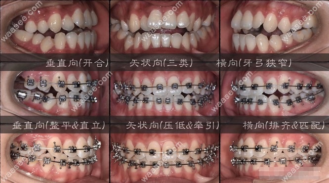 开颌牙齿矫正对比案例图.png