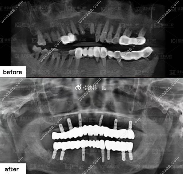 我做了种植牙前后CT对比效果图