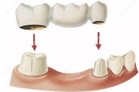 假牙种类辣么多,选可摘义齿与固定义齿的区别大吗?