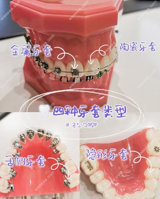 牙齿矫正有哪些方式？.jpg