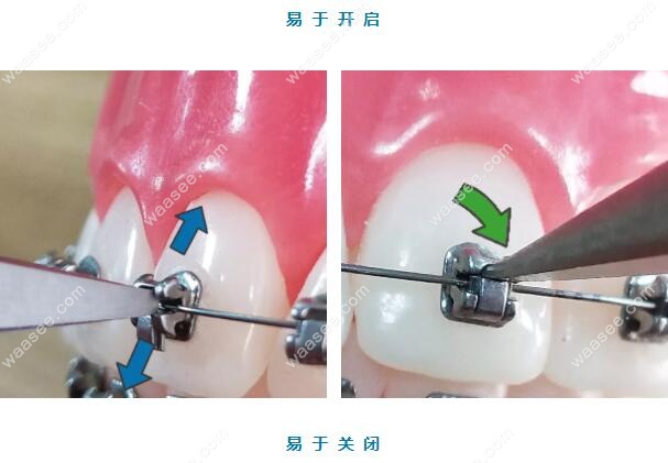 自锁托槽的优势