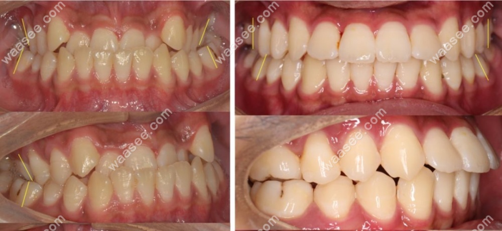 牙齿扩弓十天后脸会变更凸扩牙弓前后脸型对照图说明一切