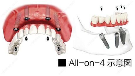 all-on-4种植牙技术