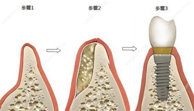 种植牙骨粉的植入步骤