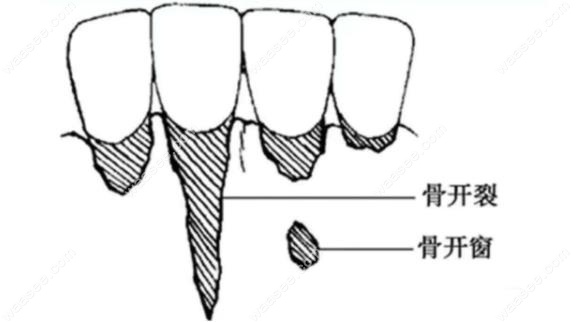 骨开窗和骨开裂的对比
