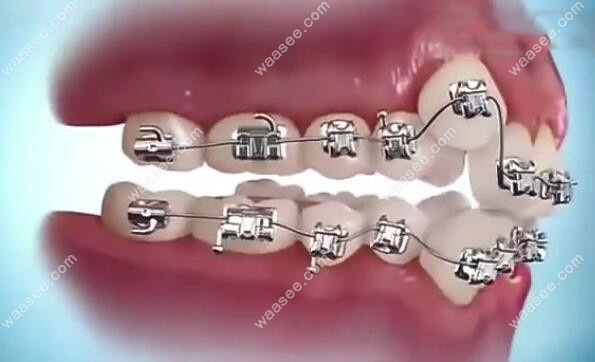 矫正牙齿安装金属牙套的过程图解,带你了解正畸详细步骤