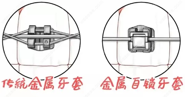 自锁托槽和传统金属托槽的区别